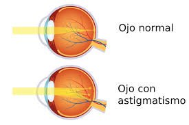 todo sobre el astigmatismo