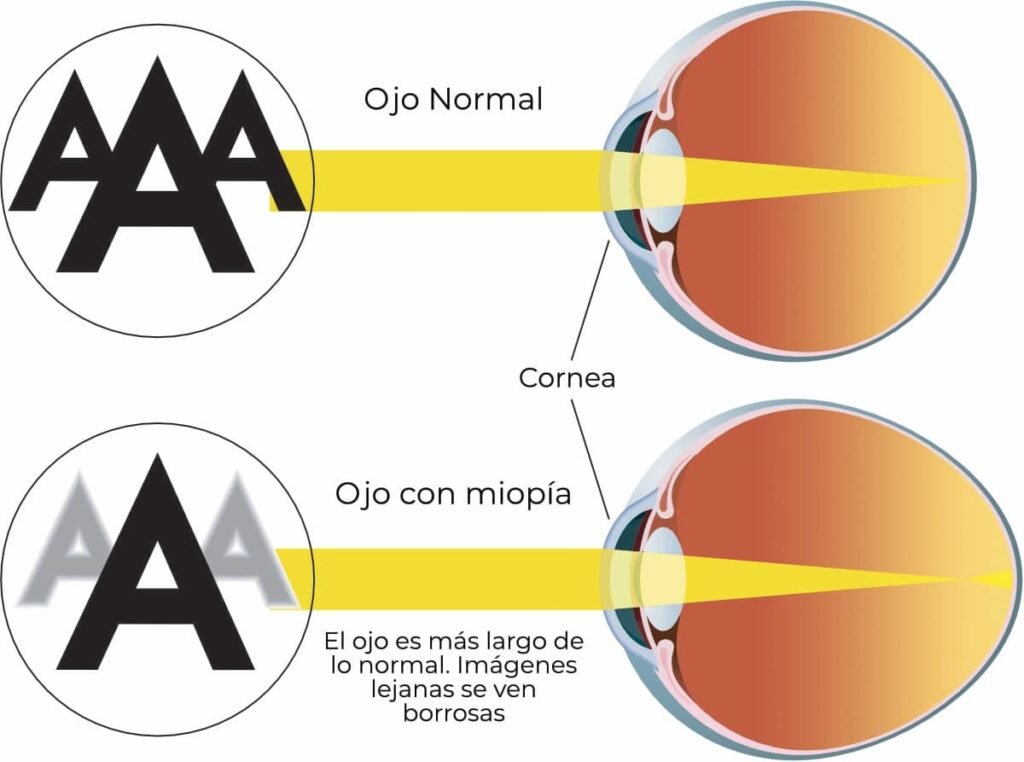 sintomas de la miopia