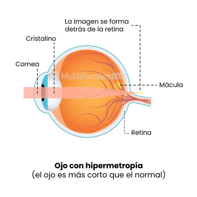 ojo con hipermetropia